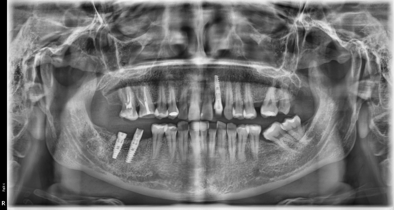 Rayos X Dental Panorámico + Ceph - Pax i Plus Vatech
